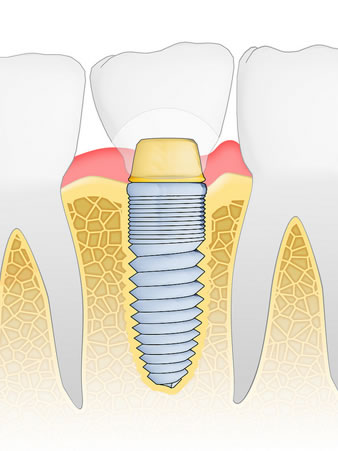 dental implants