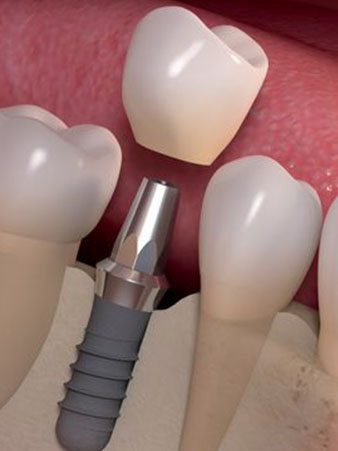 implant services