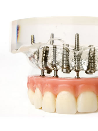 implant supported dentures