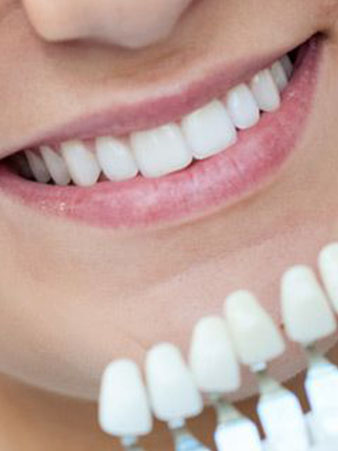 teeth whitening